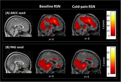 Linking Pain Sensation to the Autonomic Nervous System: The Role of the Anterior Cingulate and Periaqueductal Gray Resting-State Networks